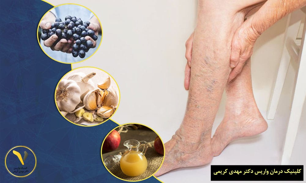 مصرف مواد غذایی مناسب بیماران دارای واریس