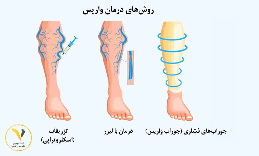 واریس قابل درمان