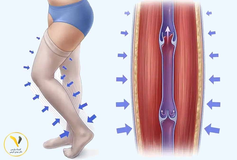 دریچههای لانهکبوتری
