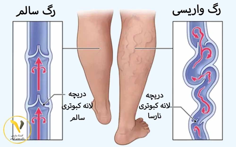 واریس